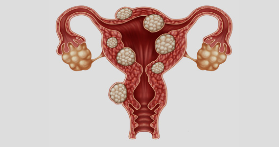 Mioma uterino                                                     
